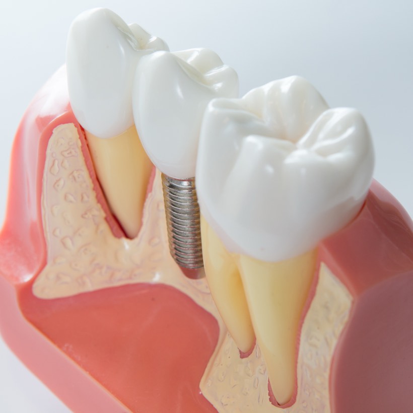 Dental implant model